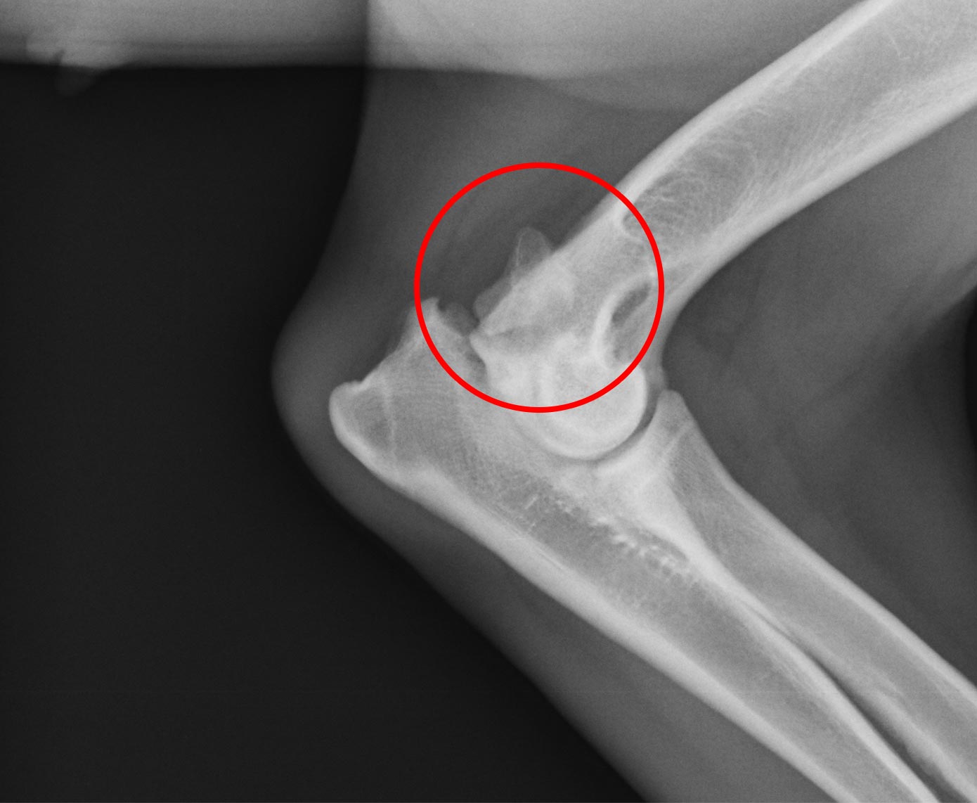 xray of the left elbow showing the anconeal fracture