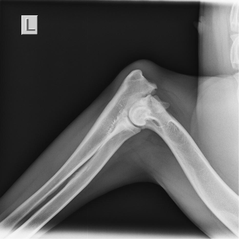 xray of the left elbow