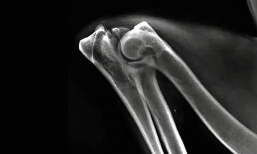 Anconeal fractures