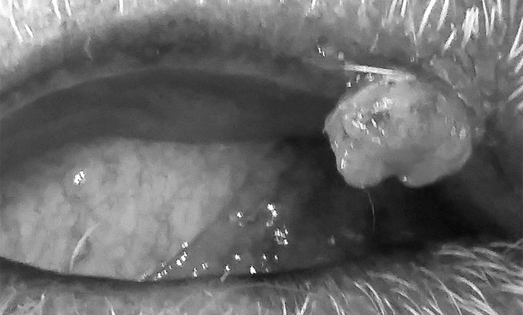 meibomian tumours