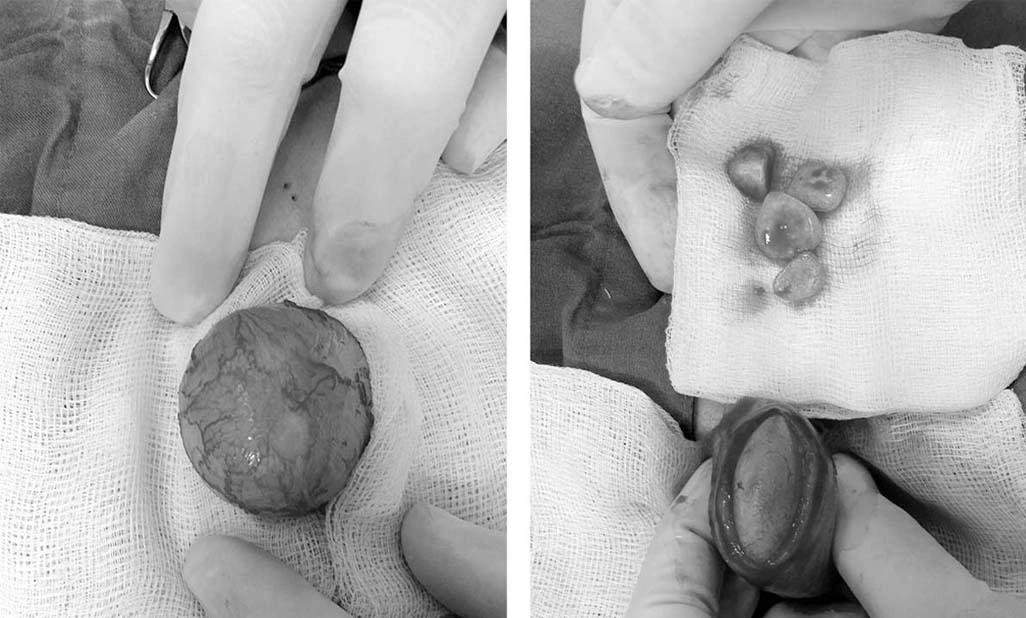 Bladder Stone Removal