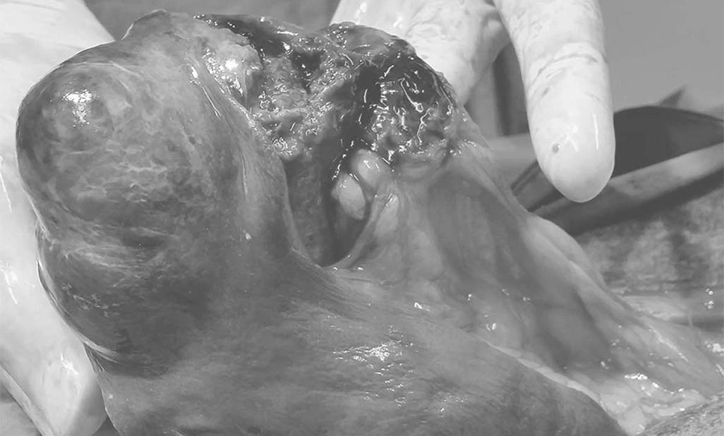 Splenic Tumours