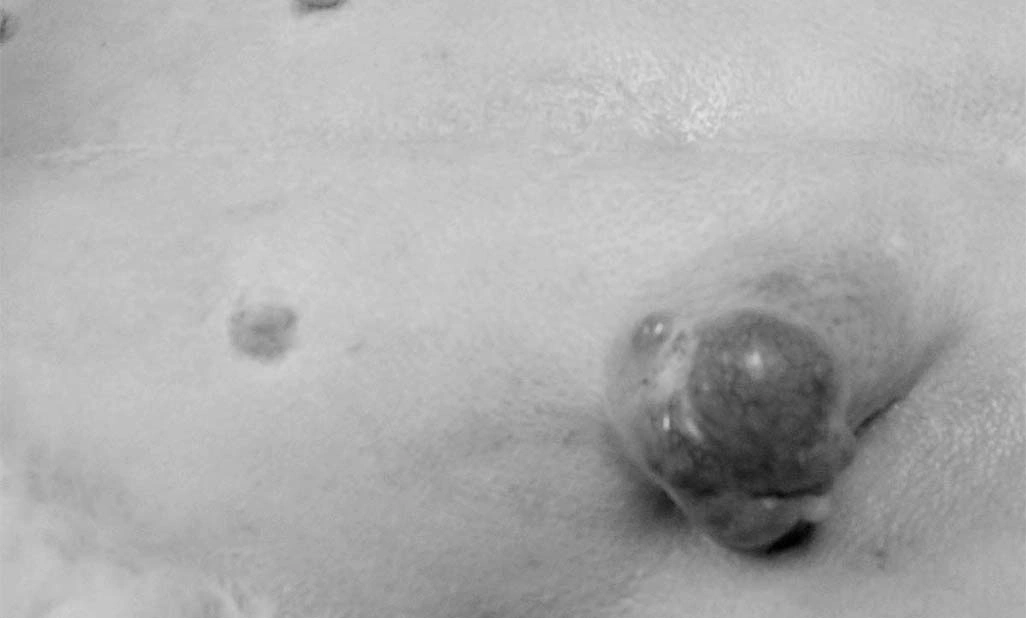mammary gland cancers surgery