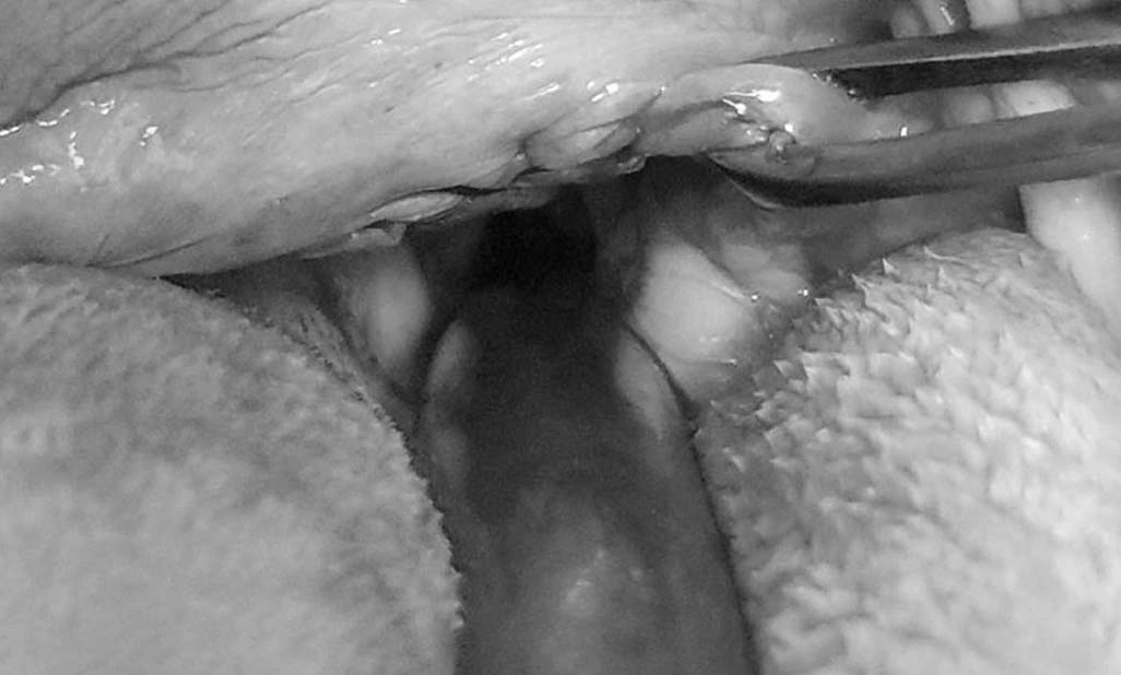 Soft palate resection